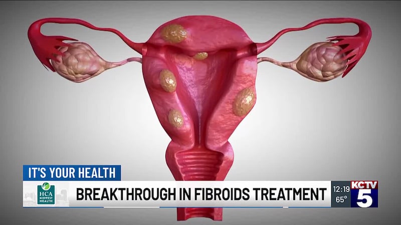 If you are a women over 30 years old, you may be very familiar with the term Fibroids. If not,...
