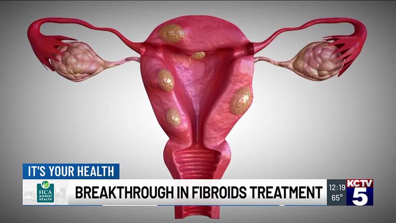 If you are a women over 30 years old, you may be very familiar with the term Fibroids. If not,...